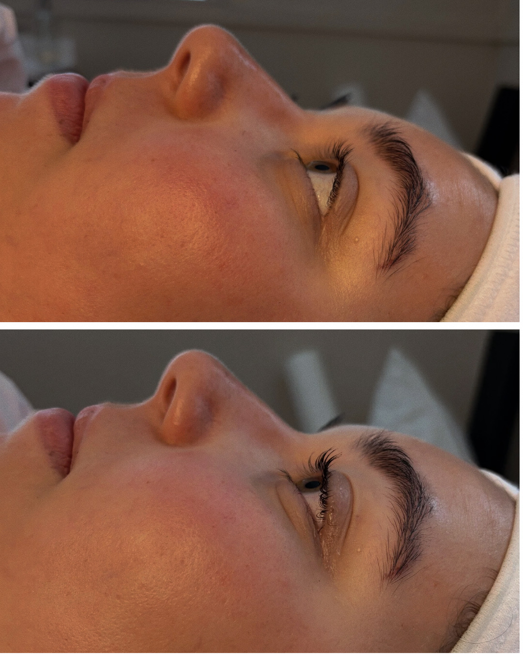 Close-up of a person's face lying down, showing the right side with closed eyes, nose, and lips, in a clinical setting.