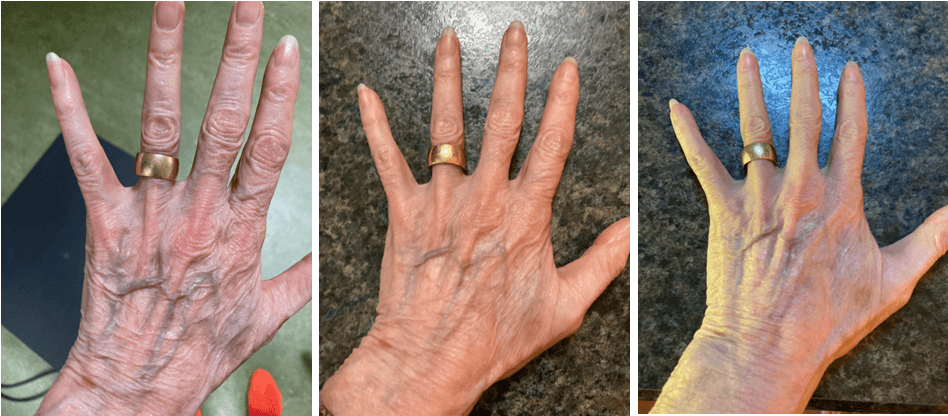 Hand with visible veins and wrinkles, fingers spread, on a dark background.